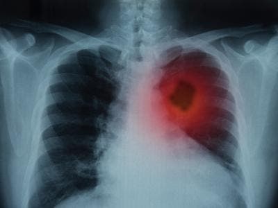 Régime cétogène cancer poumon